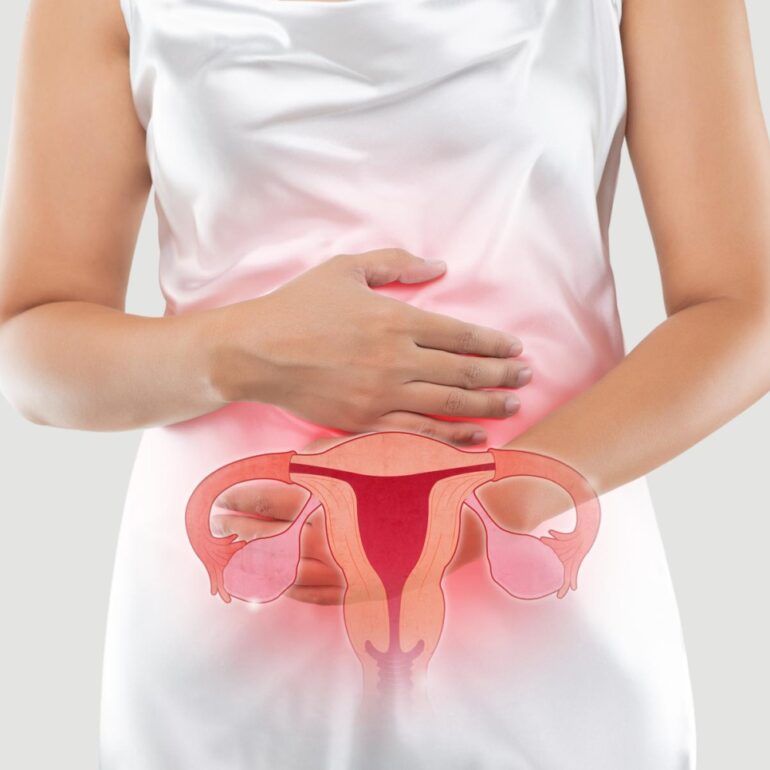 Endometriosis